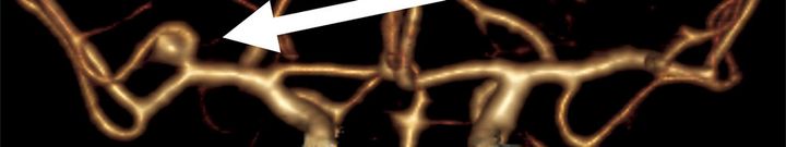 Aivoverisuonen aneurysma (Kuva: Miikka Korja)