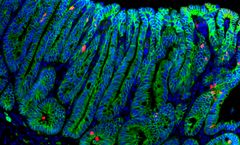 R-spondiini 1 -käsitelty suolistokasvain (adenooma). Solukalvot on värjätty vihreiksi, kuolevat solut punaiseksi ja solujen tumat siniseksi. Kuva: Marianne Lähde