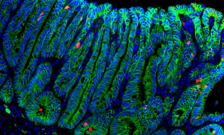 R-spondiini 1 -käsitelty suolistokasvain (adenooma). Solukalvot on värjätty vihreiksi, kuolevat solut punaiseksi ja solujen tumat siniseksi. Kuva: Marianne Lähde