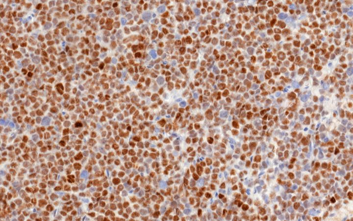 Kuvassa valomikroskooppikuva imukudossyöpäkudoksesta, jossa syöpäsolut  ilmentävät MYC -proteiinia (ruskea väri). Kuva Leppä lab.