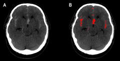 Kuvassa A näkyy pään TT-kuvassa laaja-alainen SAV. Kuvassa B on punaisella merkitty alueet, joissa algoritmi on havainnut verta.
