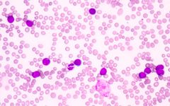 AML on aikuisten yleisin akuutti leukemia. Kuva: Mostphotos