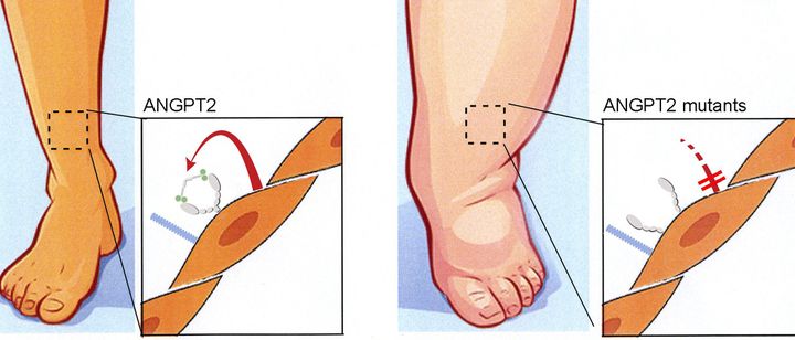 Vasemmalla angiopoietiini 2 -kasvutekijän erittymisestä imusuonen sisäpintaa verhoavista endoteelisolusta (punainen nuoli) ja kiinnittymisestä reseptoriin (harmaalla). Kuva oikealla näyttää lymfödeemapotilaan ANGPT2 -mutaation vaikutuksen: kasvutekijän erittyminen estyy ja tämä vähentää reseptorin pariutumista ja aktivaatiota johtaen jalan turvotukseen. Kuva: Alitalo Lab