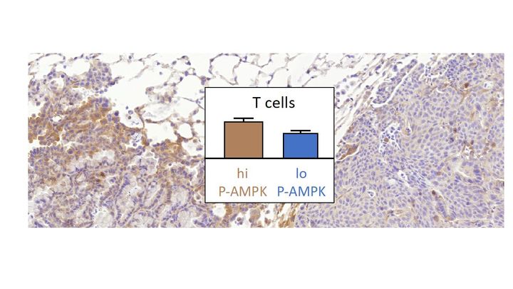 Keuhkosyöpäpotilailla inaktiivinen AMPK (lo-P-AMPK) korreloi T-solujen alhaisen määrän kanssa. Uusi biomarkkeri voi auttaa auttaa ennustamaan immunoterapioiden sopivuutta keuhkosyöpäpotilaille. (Kuva: Pekka Päivinen)