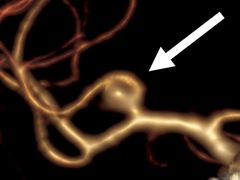 Aivoverisuonen pullistuma (Kuva: Miikka Korja)