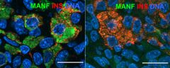 Hiiriin siirrettyjä kantasoluperäisiä beetasoluja. Vasemmalla insuliinimutaatiota kantavat solut erottuvat puna-vihreinä solustressin takia. Oikealla mutaatio-korjatut terveet solut näkyvät punaisina. (Kuva: Otonkoski Lab)