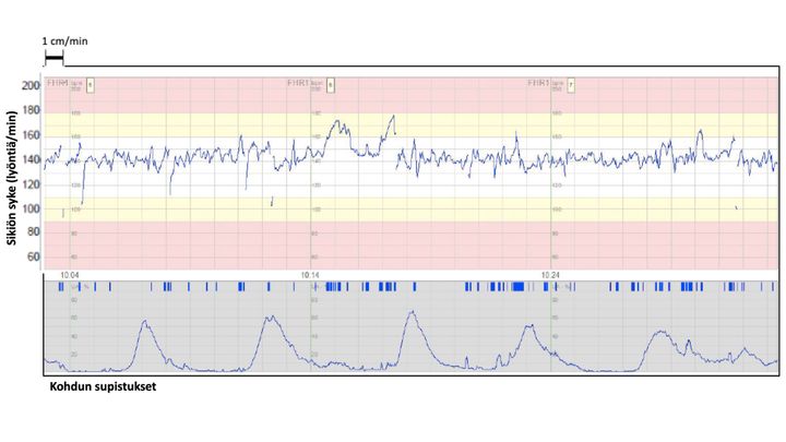 Normaali, hyväkuntoisen sikiön synnytyksenaikainen KTG-rekisteröinti.