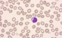 Yksittäinen LGL-leukemiasolu. Kuva: Claudiu Cotta.