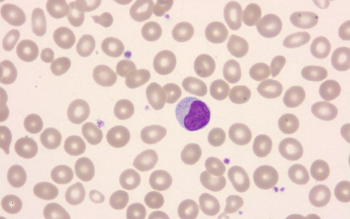 Yksittäinen LGL-leukemiasolu. Kuva: Claudiu Cotta.