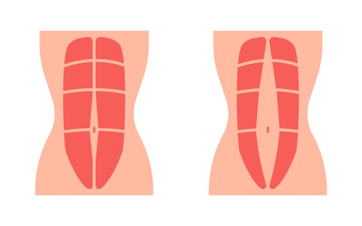 Raskauden aikana suorat vatsalihakset erkaantuvat toisistaan. Kuva: Mostphotos