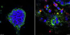 Yhdistelmähoito tuhoaa tehokkaasti kolmiulotteisessa viljelmässä kasvatettua rintasyopäkudosta. Vasemmassa kuvassa on hoitamatonta syöpäkudosta, oikealla taas yhdistelmähoidolla käsiteltya tuhoutuvaa kudosta. Vihreä väri merkitsee syöpäsoluja, punainen on apoptoottisen solukuoleman merkkiaine. (Kuva: Klefström Lab)