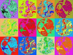 Laskennallinen analyysi auttaa tunnistamaan luuydinnäytteistä piirteitä, jotka ovat ihmissilmälle vaikeasti tunnistettavia. Lähde: Machine Learning of Bone Marrow Histopathology Identifies Genetic and Clinical Determinants in MDS Patients. Oscar Brück, Susanna Lallukka-Brück, Helena Hohtari, Aleksandr Ianevski, Freja Ebeling, Panu E. Kovanen, Soili Kytölä, Tero Aittokallio, Pedro Marques Ramos, Kimmo Porkka and Satu Mustjoki. Blood Cancer Discov March 15 2021. DOI:10.1158/2643-3230.BCD-20-0162
