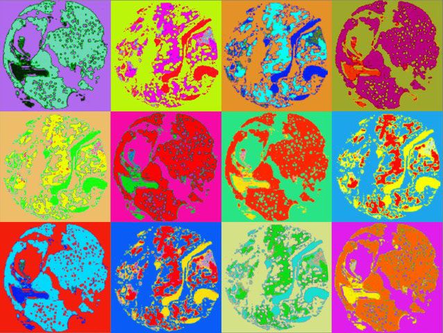 Laskennallinen analyysi auttaa tunnistamaan luuydinnäytteistä piirteitä, jotka ovat ihmissilmälle vaikeasti tunnistettavia. Lähde: Machine Learning of Bone Marrow Histopathology Identifies Genetic and Clinical Determinants in MDS Patients. Oscar Brück, Susanna Lallukka-Brück, Helena Hohtari, Aleksandr Ianevski, Freja Ebeling, Panu E. Kovanen, Soili Kytölä, Tero Aittokallio, Pedro Marques Ramos, Kimmo Porkka and Satu Mustjoki. Blood Cancer Discov March 15 2021. DOI:10.1158/2643-3230.BCD-20-0162