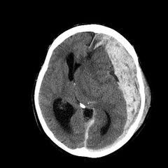 Pään TT-kuva isosta traumaattisesta kovakalvonalaisesta verenvuodosta (R. Raj / HYKS neurokirurgian yksikkö)