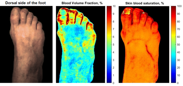 Kehitetty järjestelmä paljastaa diabetesta sairastavien potilaiden ihon veren mikroverenkierron ja ihorakenteen varhaiset muutokset.