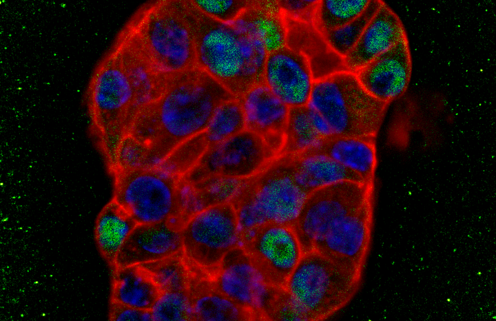 Tutkijaprofessori Juha Klefströmin laboratoriossa tutkittua rintasyöpäsolukkoa. MYC-proteiinia ilmentävät solut kuvassa vihreällä. Kuva: Pauliina Munne