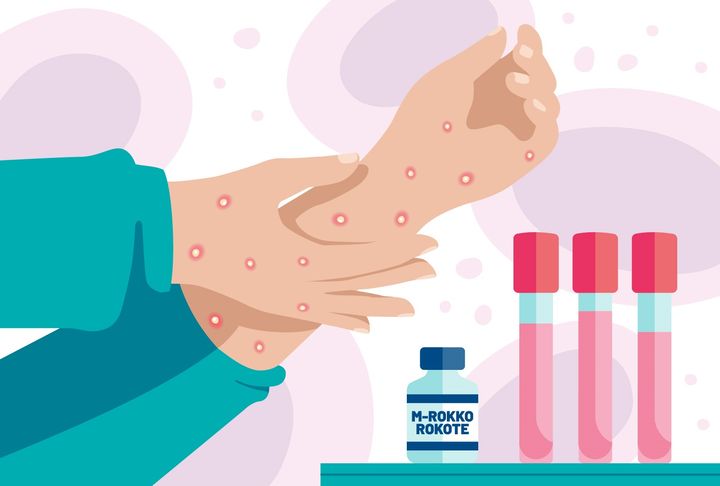 Mpox (formerly monkeypox) is an infectious disease caused by the monkeypox virus (MPXV).First symptoms may include fever, headache, swollen lymph nodes, back pain, muscle pain and fatigue. An infected person may develop reddish skin changes with pimples or blisters, especially in the face, limbs and genital area.