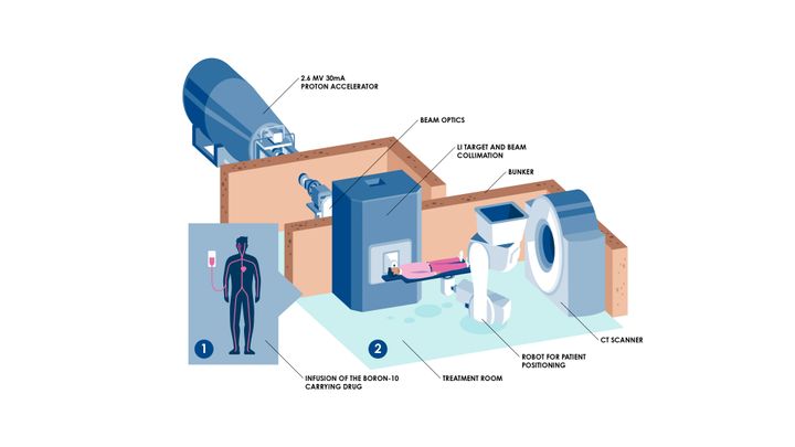Before the neutron irradiation, the patient is administered a boron delivery agent intravenously. The delivery agent transports the boron into the cancer cell. At the top in in the image is the particle accelerator which produces a proton shower, in the middle is the target, which turns protons into neutrons, and on the bottom is the treatment room where the neutrons are targeted toward the patient’s tumor. The treatment room is also equipped with a CT scanner to ensure the patient's correct position before the treatment.