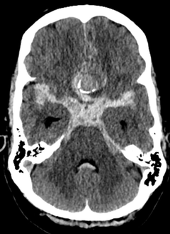CT scan of a human brain showing detailed cross-sectional imagery.