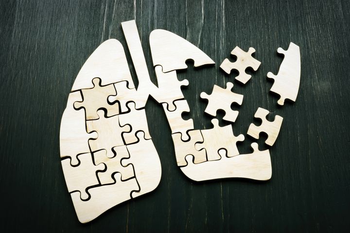 Immuunivasteen geenit vaikuttavat yksilön keuhkosyöpäriskiin, osoittaa tuore tutkimus.