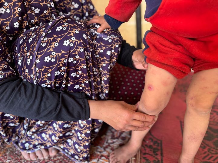 Kuvassa näkyvät naisen ja lapsen vartalon alaosa. Lapsen housujen lahkeet on nostettu ylös. Lapsen jalkojen ihossa näkyy paljon punaisia läikkiä. Joissain kohtaa iho on rikki.