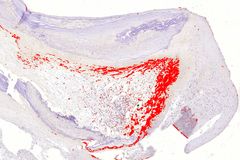 Histologinen kuva, jossa näkyy bakteeribiofilmi sepelvaltimon kolesterolia sisältävän ahtauman reunalla.