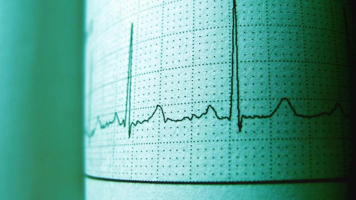 Elektrokardiogrammi-kaavio (EKG), jossa näkyy sydämen sähköinen aktiivisuus, vihertävällä taustalla.