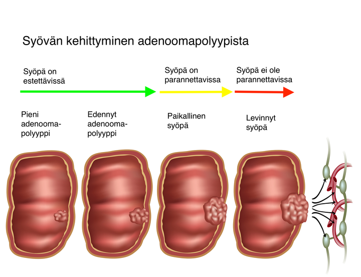 Suolistosyöpä kehittyy vaiheittain hyvänlaatuisista polyypeista.