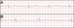 Sydänfilmi. Paneelissa A on normaali rytmi. Matalat P-aallot esiintyvät säännöllisesti ennen teräviä kammiopiikkejä. Tyypillistä eteisvärinää kuvaavasta B-paneelista puuttuvat P-aallot niiden korvautuessa tasaisella värinällä. Lisäksi kammioiskut ovat muuttuneet epäsäännöllisiksi.