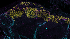 Syöpä imusolmukeessa.