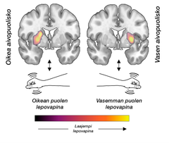 Havainnekuva aivojen dopamiinitoiminnan aktivaatiosta oikean ja vasemman puolen vapinassa.