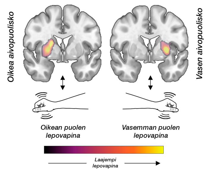 Havainnekuva%20aivojen%20dopamiinitoiminnan%20aktivaatiosta%20oikean%20ja%20vasemman%20puolen%20vapinassa.