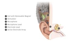 MED-EL Launches World's First Commercially Available Totally Invisible Cochlear Implant.